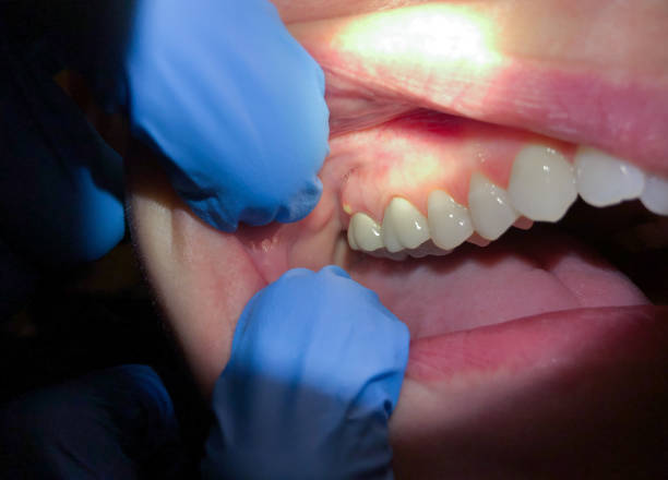 Best Emergency Dental Care for Abscessed Tooth in Oak Ridge, TN